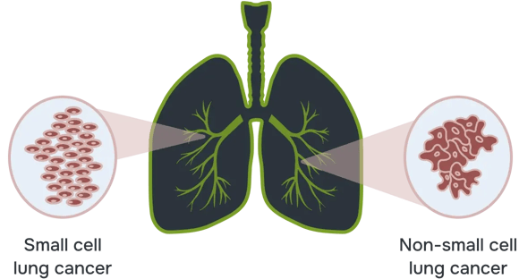 preview-lung-cancer (1)