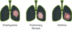 preview-lung-disease-1