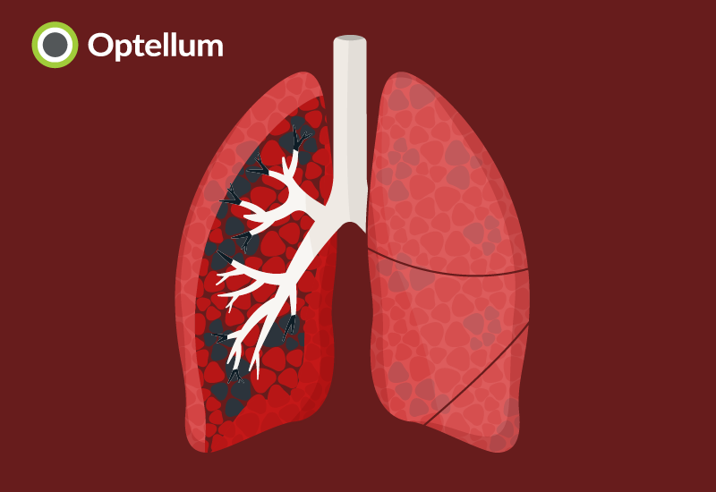 Optellum shows neural networks can robustly quantify emphysema from CT images