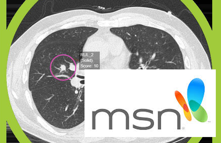 AI breakthrough could speed up lung cancer diagnosis &ndash; and save the NHS millions