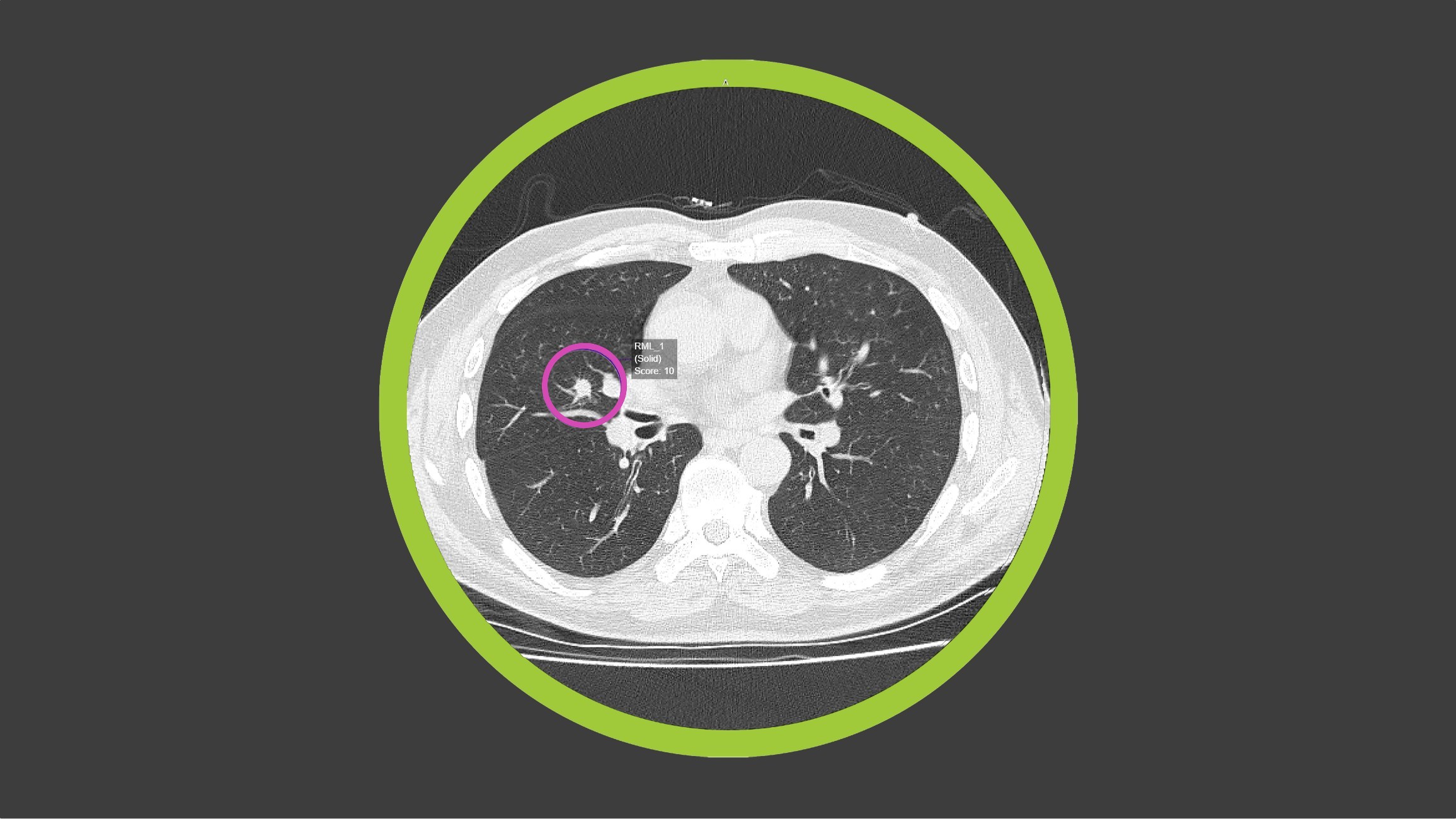 Optellum and J&J to Use AI to Transform Lung Cancer Treatment