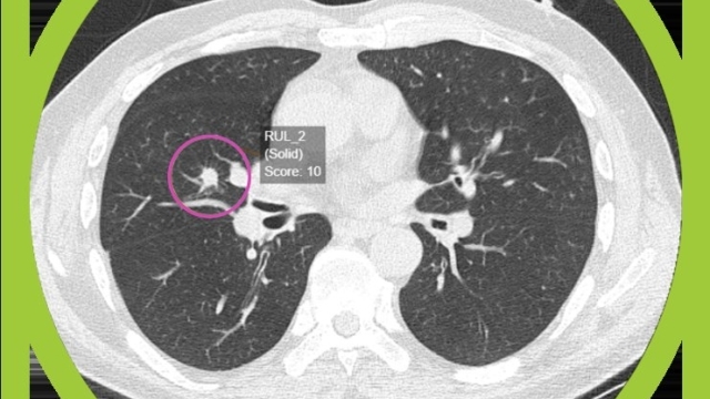 AI breakthrough could speed up lung cancer diagnosis &ndash; and save the NHS millions