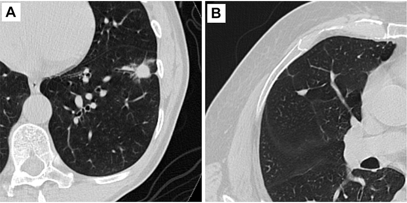 PRESS RELEASE: Researchers Use AI to Predict Cancer Risk of Lung Nodules