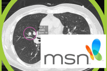 Read more about the article AI breakthrough could speed up lung cancer diagnosis – and save the NHS millions