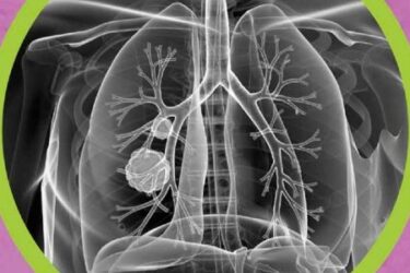 Read more about the article Optellum, Johnson & Johnson Collaborate on AI-Powered Lung-Health Initiative