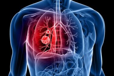 Read more about the article Optellum Joins J&J’s Lung Cancer Initiative