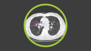 Read more about the article Optellum and J&J to Use AI to Transform Lung Cancer Treatment