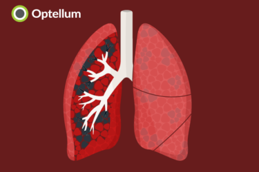 Read more about the article Optellum shows neural networks can robustly quantify emphysema from CT images